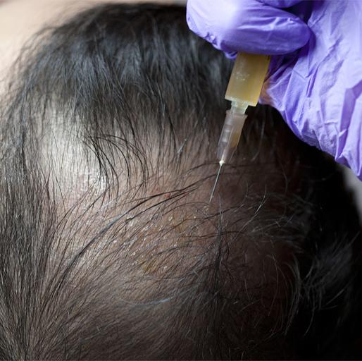 PRP Hair Treatment